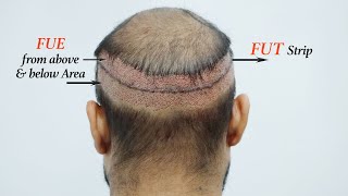 Grade 6 Hair Transplant FUT amp FUE Combine RESULTS at Medispa India  Dr Suneet [upl. by Ozne]