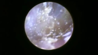 Dust Mites In Human Ears Feed On Skin [upl. by Eilzel]