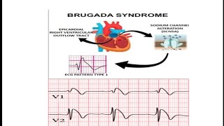 Brugada Syndrome  ECG Changes in Brugada Syndrome  Brugada Sign  Symptom and Signs in Brugada [upl. by Yggam278]