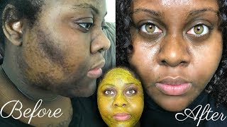 5 DAY TURMERIC FACE MASK CLEARED MY HYPERPIGMENTATION IM SHOOK [upl. by Neelie423]