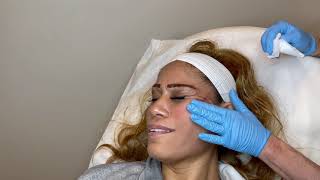 PDO Thread Lift treatment to lift the Mid and Lower Face after Dermal Filler and Botox [upl. by Eyeleen]