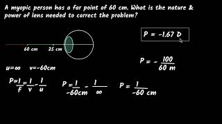 Numerical on defects of vision  The human eye amp colourful world  Physics class 10  Khan Academy [upl. by Ozzy]