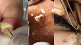 Unleashing Pimple Popper The Ultimate Satisfaction [upl. by Liatrice]