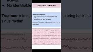 Ventricular Fibrillation [upl. by Calore]