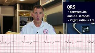 Bradycardia ECG Rhythm Interpretation [upl. by Annayar]