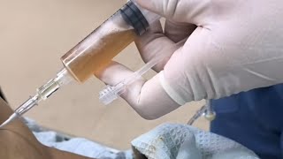 Como Hacer Una PARACENTESIS Abdominal  Prácticas De Enfermería  enfermeria viralvideo [upl. by Nadabas]