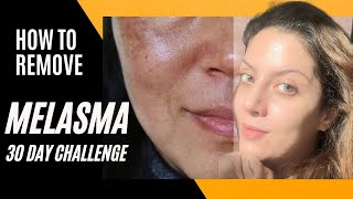 Melasma Removal at Home I Melasma Remove cream I Melasma Skin Care Regimen Routine [upl. by Ulphiah]