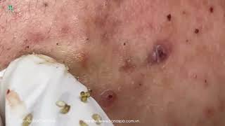 Big Cystic Acne Blackheads Extraction Blackheads amp Milia Whiteheads Removal Pimple Popping [upl. by Nedap]