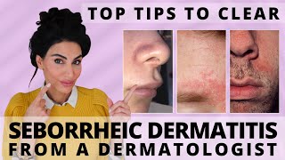 Top Tips to Clear Seborrheic Dermatitis  Dermatologist Deep Dive [upl. by Yclek483]