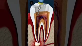 Root Canal Treatment science sciencefacts [upl. by Adnohsad]