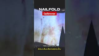 ส่องเส้นเลือดฝอย บริเวณโคนเล็บ ด้วยกล้องจุลทรรศน์ Nailfold Capillaroscopy [upl. by Hailey]