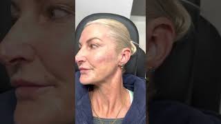 Cheek dermal filler  Cannula fanning technique  Newcastle Cosmetic Doctor  Patient experience [upl. by Shanks]