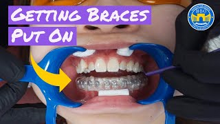 Process of Getting Braces [upl. by Angelique]