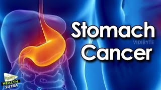 Stomach Cancer  Symptoms Causes Risk Factors and Treatment  Health Tips [upl. by Noira]