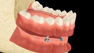 Fix rögzített fogsor  MindentMent® Fogászat [upl. by Buonomo116]