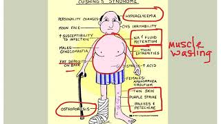 Endocrine Disorders [upl. by Trumann334]