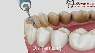 Diş Taşı Temizliği Profesyonel Diş Temizliği [upl. by Anawd]