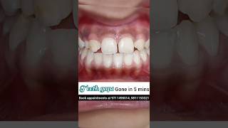 Teeth Gaps gone in just 5 minutes No braces Dr Srishti Bhatia smilemakeover dentist [upl. by Pascoe]