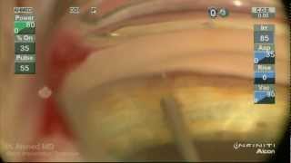 iStent Trabecular MicroBypass Implantation Ike Ahmed [upl. by Prisca]