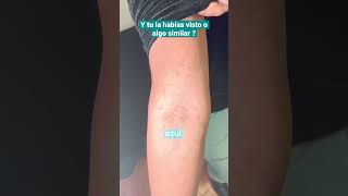 Manchas que quizá 🤔 no conocías dermatitis cenicienta y tú ya sabías  O casos similares [upl. by Lehcear]