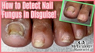 GET RID OF TOENAIL FUNGUS FOR GOOD PEDICURE TRAINING [upl. by Anabel997]