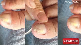 Cleans fungal skin and toenail corners in 1 second  part 94NhaNguyenPhanThiet [upl. by Ajam733]