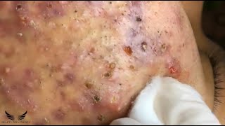 Blackhead Whitehead Removal  Cystic Acne Treatment  Elderly Pimple Popping  Facial Acne Spa 082 [upl. by Aksehcnarf954]