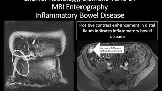 MRI Enterography Inflammatory Bowel Disease [upl. by Mathilda]