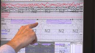 Reading Sleep Study Results Identifying Sleep Apnea [upl. by Ytak]