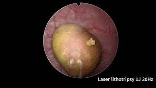 SLIM HOLEP 22Fr First stage of Surgery plus laser Cystolithotripsy [upl. by Melcher]