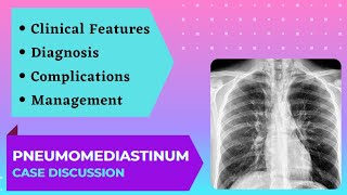 Case Presentation  Acute Chest Pain  Pneumomediastinum [upl. by Eniluap]