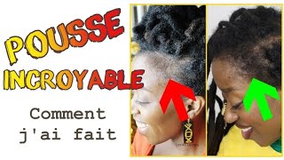 Tempes Comment jai fait repousser mes cheveux des TEMPES  Méthode 100 naturelle alopeciepousse [upl. by Ramburt]