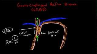 Pathophysiology of Gastroesophageal Reflux Disease GERD [upl. by Nairod]