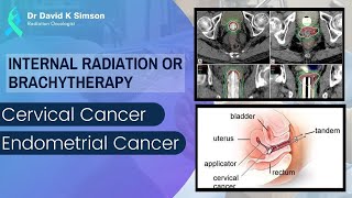 Brachytherapy or Internal Radiation of Cervical amp Endometrial Cancer  Dr David K Simson [upl. by Petronilla]