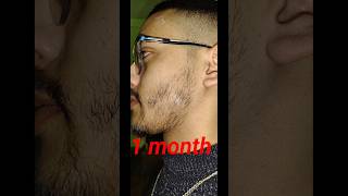 1 month beard growth by minoxidil [upl. by Ybloc]