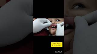 Ectodermal Dysplasia Syndrome dentistdentistnearby [upl. by Laenaj]