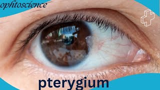 what is Pterygium Pterygium causes symptoms Treatment prevention [upl. by Conard761]