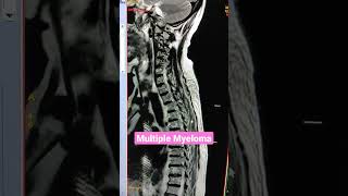 Multiple Myeloma Spine MRI viral mri youtubeshorts [upl. by Golda]