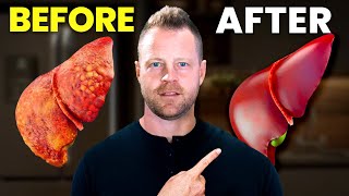 How to Fix Your Fatty Liver at Home5 Tips [upl. by Emmeram]