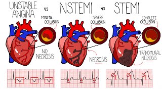 Acute Coronary Syndrome Heart Attack  Unstable Angina vs NSTEMI vs STEMI  With ECGs [upl. by Ankeny]