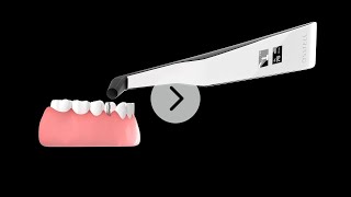 How to measure implant stability with Osstell Beacon [upl. by Brion]