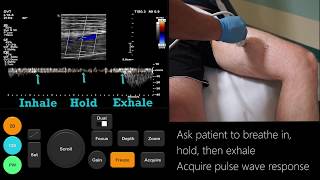 Ultrasound Tutorial DVT  Lower Limb Veins  Radiology Nation [upl. by Doughman338]