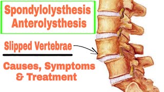 Spondylolisthesis or Anterolisthesis Causes symptoms and Treatment in UrduHindi [upl. by Ardine319]