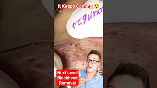 NEXT LEVEL BLACKHEAD REMOVAL  It Just Kept Coming shorts [upl. by Fisher]