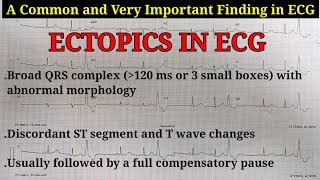 ECG Ectopics Explained  Learn about Ectopics APCs amp VPCs  Ventricular Trigeminy ECG [upl. by Dave]