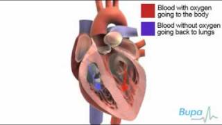 Heart valve replacement surgery [upl. by Eilyk]