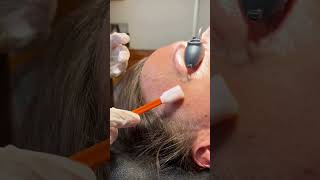 Facial with MICRONEEDLING [upl. by Elburr860]