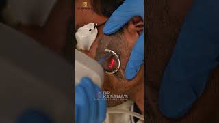 co2 Laser Treatment for Birthmark Removal [upl. by Baudoin]