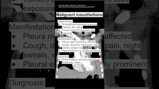 Malignant mesothelioma [upl. by Cristiona]