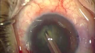 Large Posterior Polar Cataract [upl. by Hardunn]